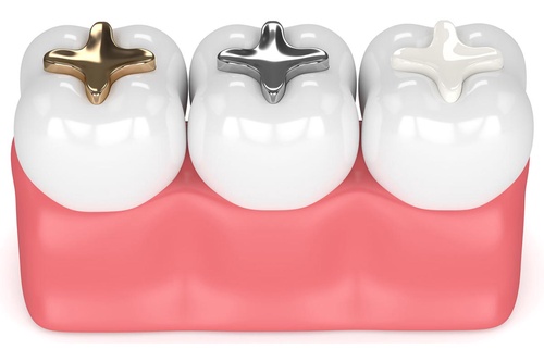 "Say Goodbye To Cavities Through Dental Filling Procedure"