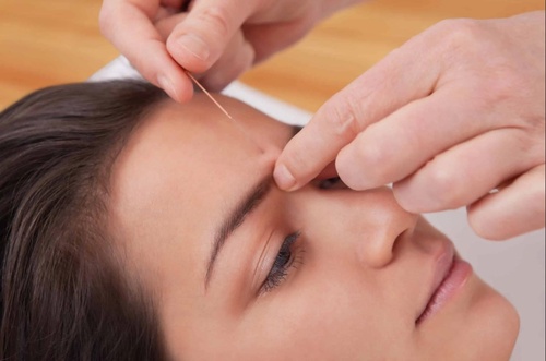 Acupuncture Facelift: What Is Face Acupuncture For