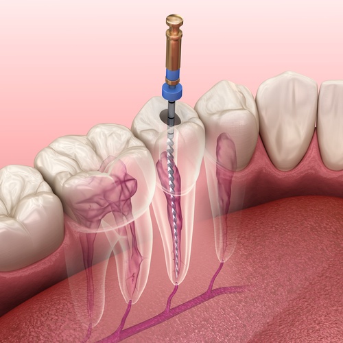 When Do You Need a Root Canal?