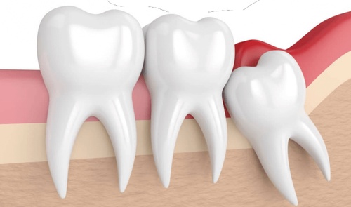 Wisdom Teeth Removal London: A Complete Guide