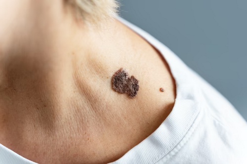 Removing Moles: A Guide to Safe and Effective Mole Removal in Birmingham