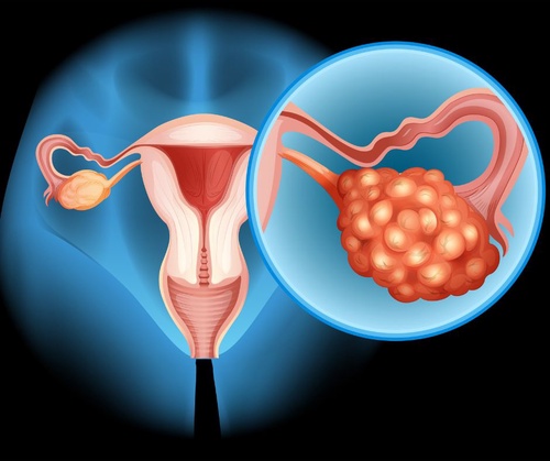 5 Natural Ways to Treat Polycystic Ovary Syndrome (PCOS) Effectively