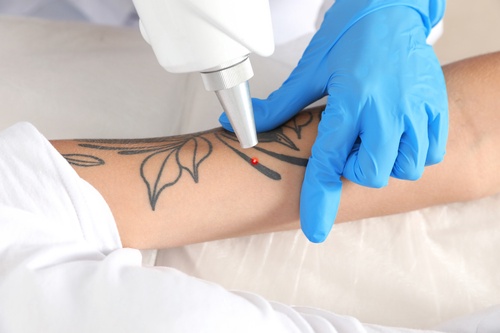 Laser Tattoo Removal Procedure: Benefits and Risks
