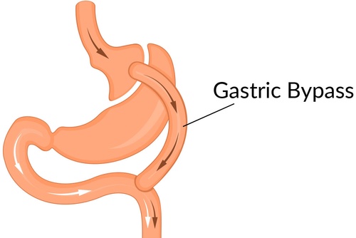 Gastric Bypass: An In-depth Analysis of How this Surgical Procedure Revolutionizes Weight Loss