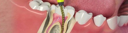 All About Root Canal Treatment In Delhi