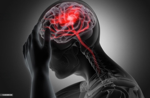 How long does migraine last, what is it, & what are its stages?