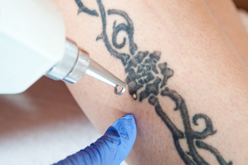 Things about laser tattoo removal