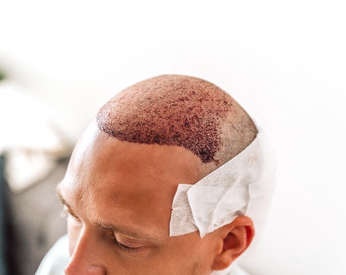 Why One Must Follow Proper Precautions After Hair Transplant Surgery
