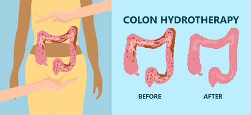 How Does Colon Hydrotherapy Work?