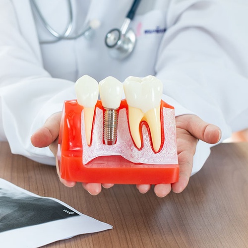 Which is the best place for dental implants?