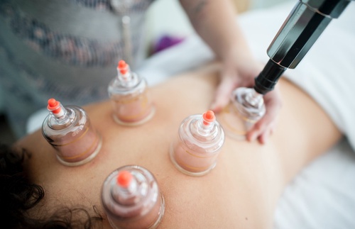 Exploring the Ancient Art: Unveiling the Wonders of Cupping Therapy