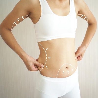 Laser Liposuction: Sculpting Your Body with Precision