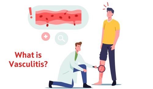 What is Vasculitis and How to Treat It?