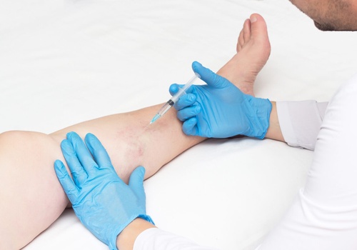Understanding Laser Treatment For Spider Veins In Long Island: Will They Come Back?