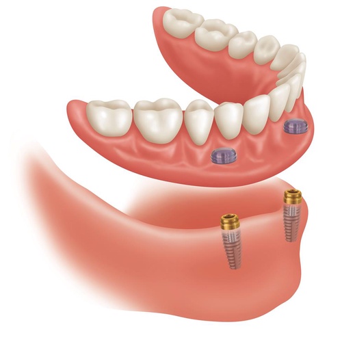 How can implant dentures be a painless solution to help you overcome your dental anxiety?