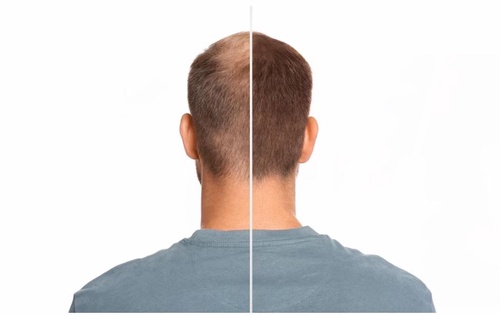 Hair Transplant Types: Which Is the Best Method for Hair Transplant?