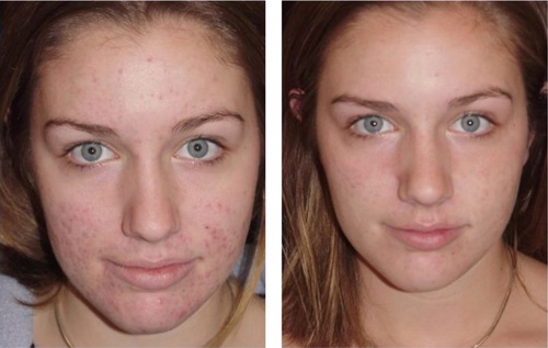 Niacid Serum For Acne Scars: All You Need To Know