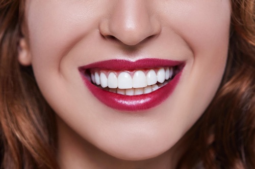 Unlock Your Perfect Smile with Porcelain Veneers in Rochdale