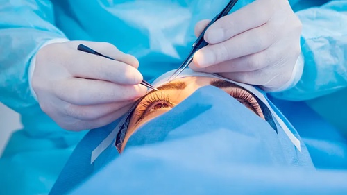 Latest Advances in Cataract Eye Treatment