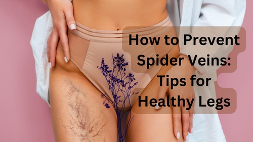 How to Prevent Spider Veins: Tips for Healthy Legs
