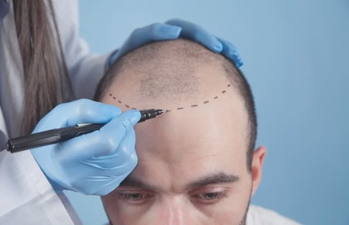 Crowning Glory Restored: Hair Transplant Masters