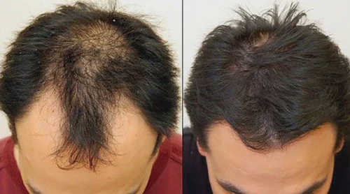 "Transforming Lives, One Hair Follicle at a Time"
