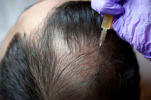 Precision Redefined: The FUE Hair Transplant Breakthrough