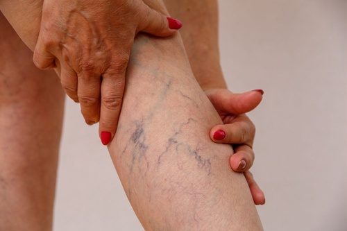 Breaking Ground Innovative Treatment Options for Varicose Veins