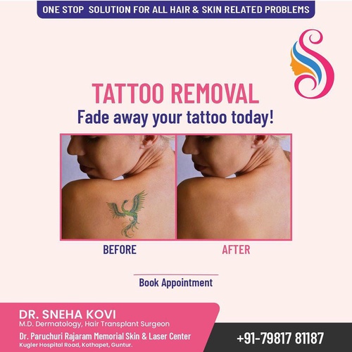 Exploring the Benefits of Laser Tattoo Removal in Guntur