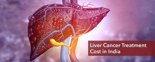 Navigating Liver Cancer Treatment: Insights and Guidance