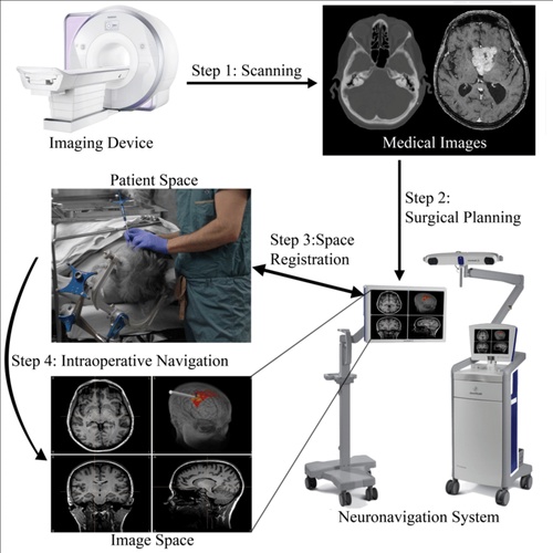 Neuro Navigation Technology how does it work in Neurosurgery?