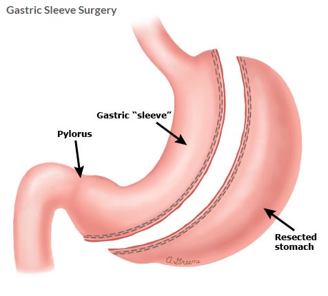 Navigating Weight Loss Options: Is Gastric Sleeve Surgery the Right Choice for You?